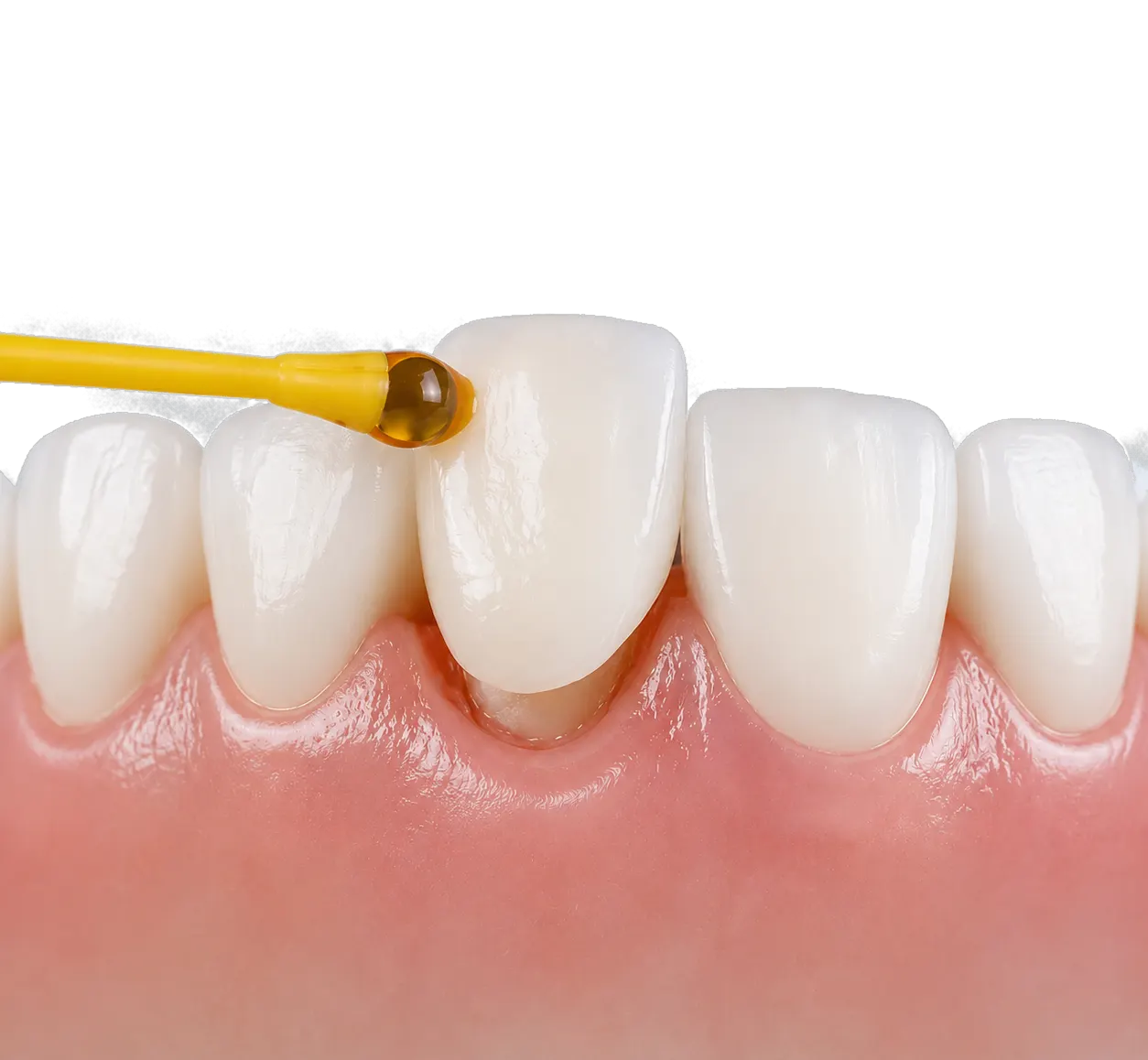 Pose d'une facette dentaire sur une incisive à la Zirconia Dental Clinic, Birkhadem, Alger