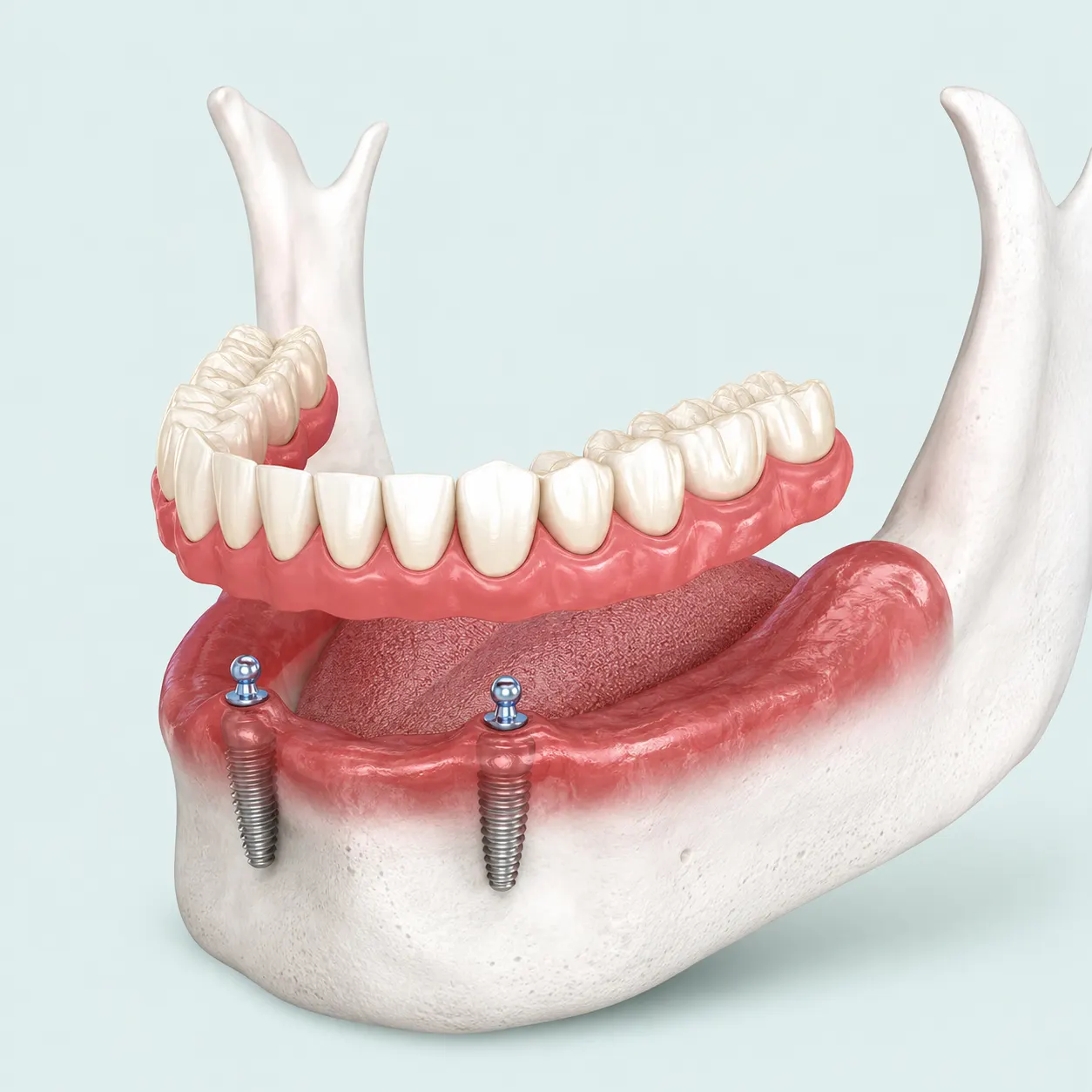 Prothèse amovible stabilisée : deux implants dentaires équipés d'attaches sur lesquels un appareil complet vient se clipser